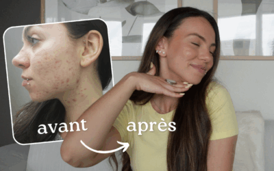 Comment j’ai soigné mon acné hormonale naturellement